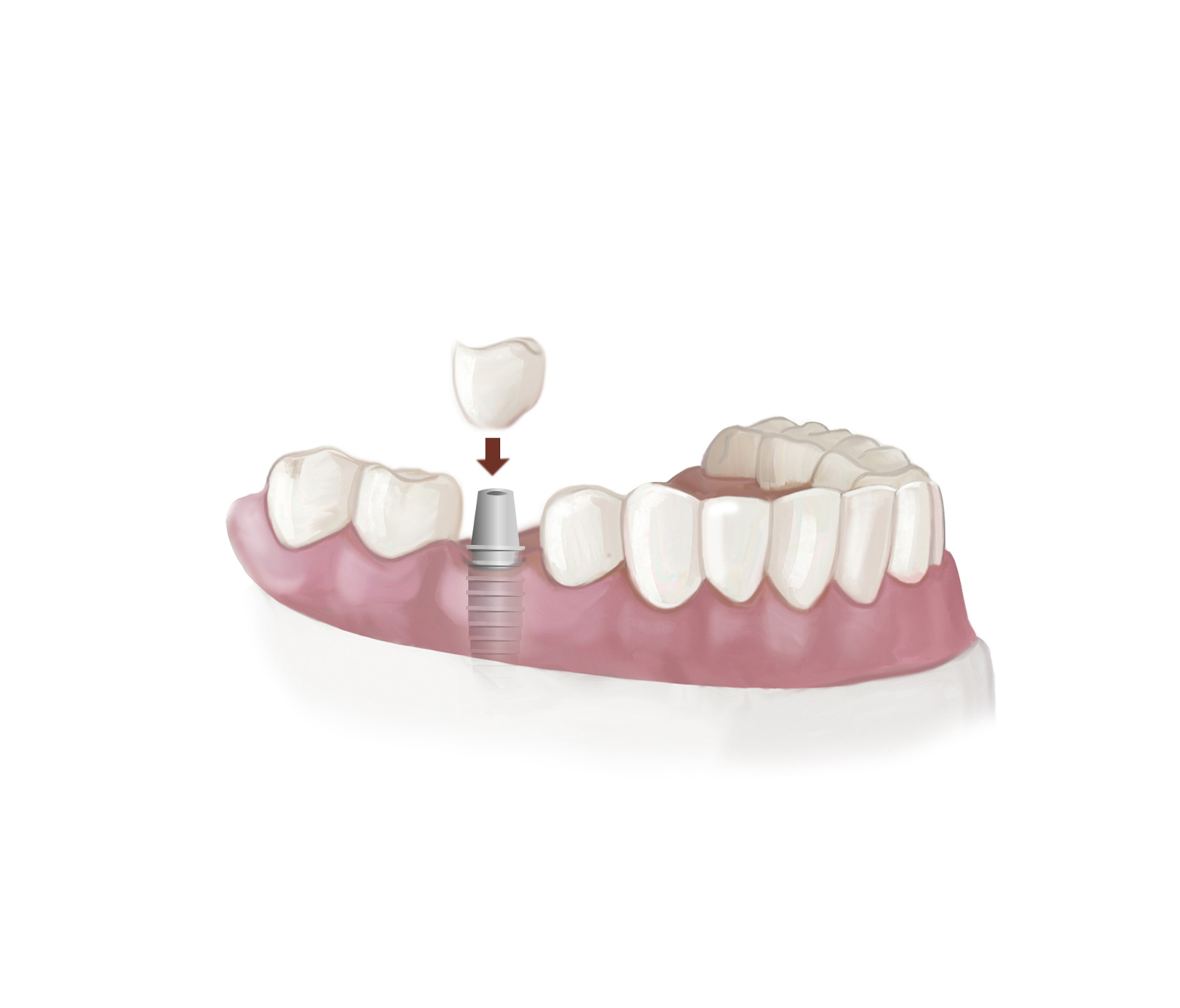 Prothèse dentaire fixe - Dentier, Bridge, Implant, Couronne - Prix et Usage