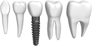 Le implant dentaire